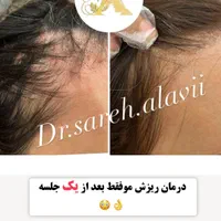 درمان ریزش مو توسط پزشک|خدمات آرایشگری و زیبایی|قم, دورشهر|دیوار