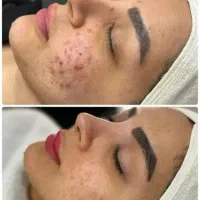 فیشال و پاکسازی تخصصی درماپلینینگ ایرانشهر