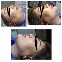 ساکشن غبغب به روش سوپر مادلینگ(وی لاین)