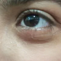 پاکسازی پوست فشیال وکاشت مژه گیاهی موقت