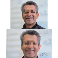 آموزش تخصصی دندانسازی(پروتز متحرک)