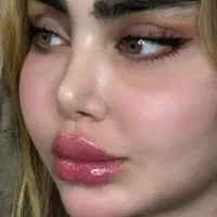 مدل فیلر و بوتاکس (فقط هزینه مواد گرفته میشود)