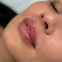 تخفیف ویژه بوتاکس فیلر و جوانسازی