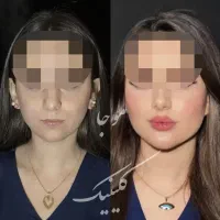 ژل،فیلر،بوتاکس،پی آر پی،مزوتراپی توسط پزشک در مطب