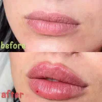 تزریق ژل بوتاکس فیلر تخفیف ویژه|خدمات آرایشگری و زیبایی|تهران, سبلان (لشگر)|دیوار