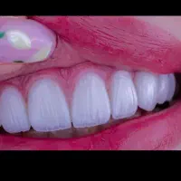 کامپوزیت دندان / ایمپلنت / لمینت دندانپزشکی