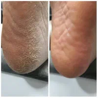 اسپا (دست وپا )