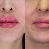 فیلر لب با بهترین کیفیت|خدمات آرایشگری و زیبایی|تهران, شهرک آزمایش|دیوار