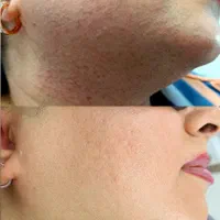 لیزرموهای زائد*ویژه بانوان رایگان|خدمات آرایشگری و زیبایی|اصفهان, بوستان آینه خانه|دیوار