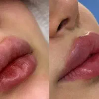 تزریق ژل|خدمات آرایشگری و زیبایی|بندر گناوه, |دیوار