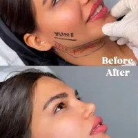 آف50%ساکشن غبغب سوپرکانتورVLineژل بینی زاویه دائمی|خدمات زیبایی و سلامت|مشهد, هفت تیر (آب و برق)|دیوار