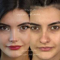 جراحی بینی با قیمت استثنایی