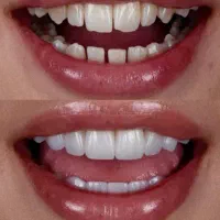 تخفیف ۵۰ درصدی لمینت و کامپوزیت
