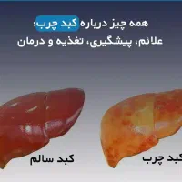درم.ان کبد چرب