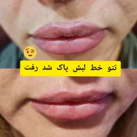 مرکز ریمو،پاک کردن،ریموو تتوابرو.بدن.خط چشم بالیزر|خدمات آرایشگری و زیبایی|شیراز, فرهنگ شهر|دیوار