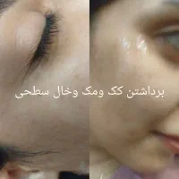 پلکسر وخال برداری ، مزونیدلینگ ، فشیال تخصصی|خدمات آرایشگری و زیبایی|مشهد, طلاب|دیوار