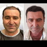 کاشت مو با تراکم باورنکردنی