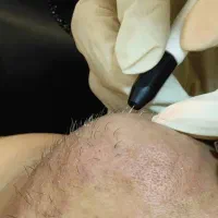 حذف دائمی موهای صورت حتی موی سفید(الکترولیز)