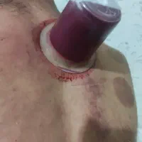 حجامت و تزریقات توسط پرستار باسابقه