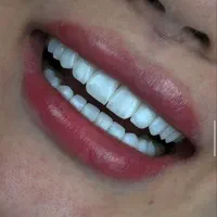 دندانپزشکی .کامپوزیت .لمینت. ایمپلنت