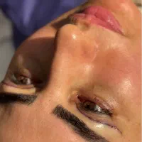 جشنواره تخفیفی بلفاروپلاستی تا پایان هفته