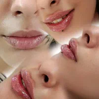 تزریق ژل فیلر بوتاکس مزوژل مزوتراپی جوانساز