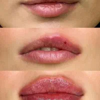 لیزرپی ار پی ژل بوتاکس فیلربادی لاغری ساکشن هایفو