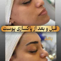 فیشال و پاکسازی پوست