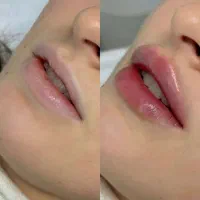ژل و بوتاکس فیلر چربی مزو|خدمات آرایشگری و زیبایی|مشهد, طلاب|دیوار