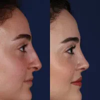 عمل جراحی بینی پیزوسرجری با بهترین کیفیت و قیمت|خدمات آرایشگری و زیبایی|رفسنجان, |دیوار