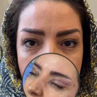 بلفاروپلاستی ۴۵۰۰/غبغب۴۵۰۰/کاشت ابرو|خدمات آرایشگری و زیبایی|ری, دیلمان|دیوار