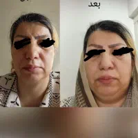 جوش لک و چین چروک امانت بریده