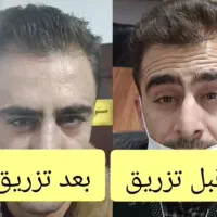 تزریق بوتاکس صورت تعریق میگرن لبخند لثه ای|خدمات آرایشگری و زیبایی|صدرا-فارس, |دیوار