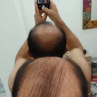 کاشت مو طبیعی در بوشهر وشیراز