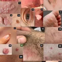 درمان ریشه ای زگیل تناسلی و تبخال تناسلی