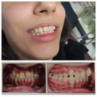 ارتودنسی کامپوزیت لمینت دندان‌مصنوعی ایمپلنت|خدمات آرایشگری و زیبایی|تهران, سلسبیل شمالی|دیوار