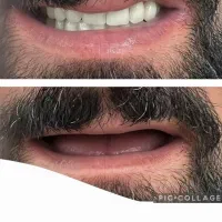 دندان مصنوعی(دست دندان )|خدمات آرایشگری و زیبایی|مرند, |دیوار