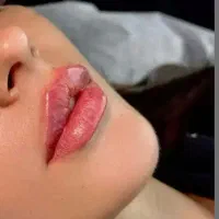 فیلر وبوتاکس ویژه ی عید