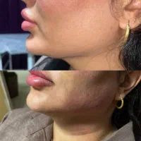 جذب نیرو دستگاه کیو سوئیچ و لاغری و زیبایی
