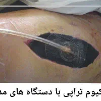 درمان قطعی زخم بستر و زخم دیابتی و زخم های مزمن|خدمات آرایشگری و زیبایی|تهران, هروی|دیوار
