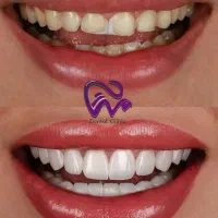 کامپوزیت دندان لبه شیشه ای فکی ۱۰ با اقساط بلندمدت