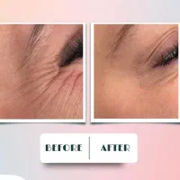 بوتاکس ، فیلر و جوانسازی