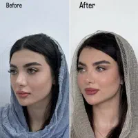 کانتورینگ لیفت فیلر بوتاکس مزو