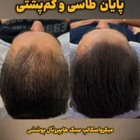 میکرو اسکالپ مکمل کاشت مو