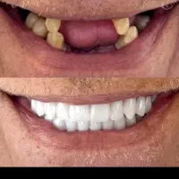 جشنواره دندانپزشکی کامپوزیت لمینت