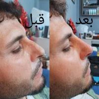 فیلر.مزو.پاکسازی  پوست و صورت .مزو .بوتاکس چربی|خدمات آرایشگری و زیبایی|اسلام‌شهر, شهرک لاله|دیوار