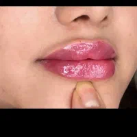 مدل ژل/فیلر لب|خدمات آرایشگری و زیبایی|تهران, قلهک|دیوار