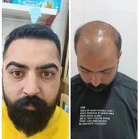 کاشت مو ابرو و ریش تارکوب|خدمات آرایشگری و زیبایی|نظرآباد, |دیوار