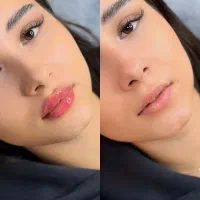 تزریق فیلر ، بوتاکس ، مزوژل (سجاد)