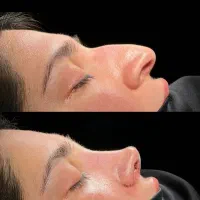 عمل زیبایی و درمانی بینی توسط جراح متخصص پلاستیک